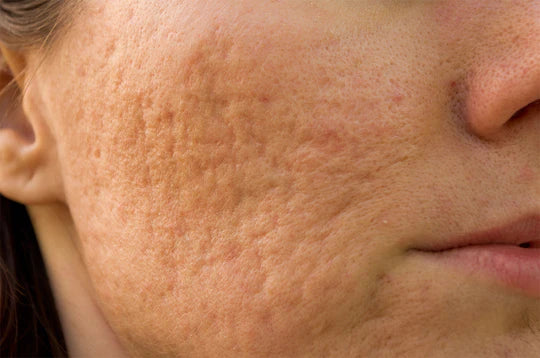 Come ridurre ed eliminare le cicatrici da acne
