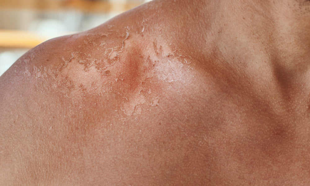 Come far rinascere la pelle dopo l’estate: peeling e scrub
