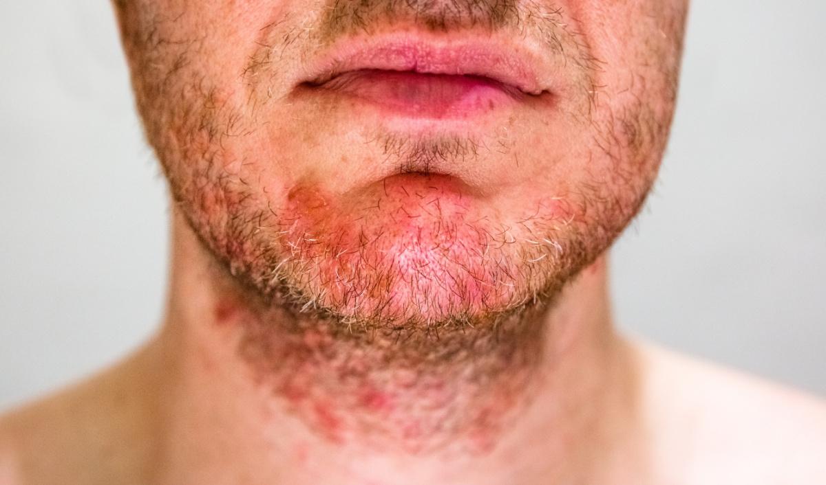 Come risolvere il problema della Dermatite?