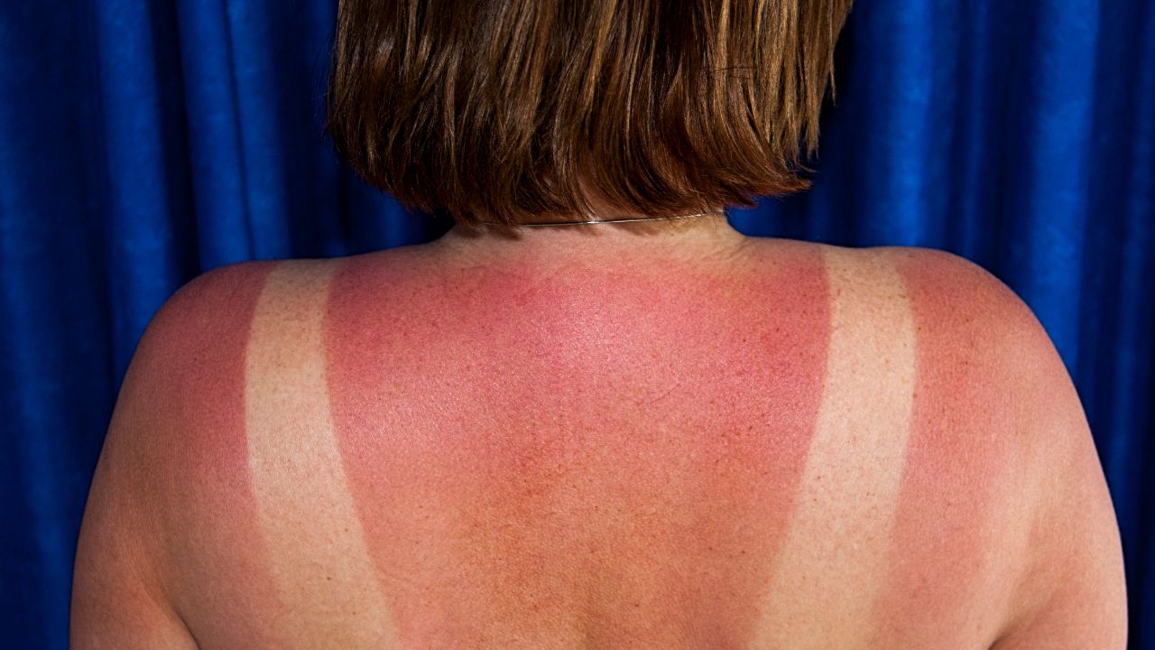 Come curare la pelle scottata dal sole? Scopri i rimedi semplici ed efficaci!
