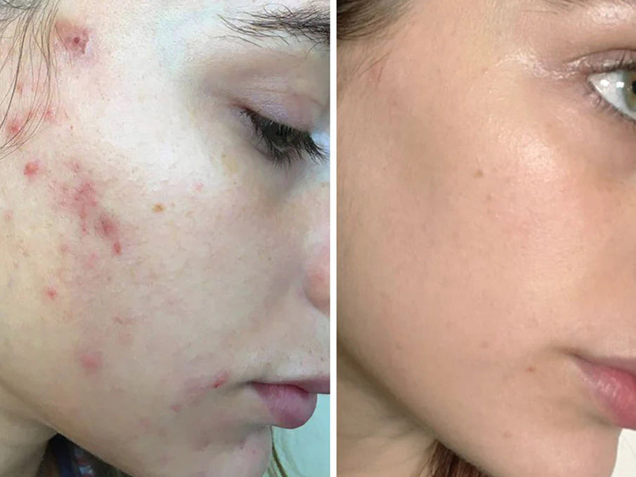 Anti inflammatory-acne treatment
