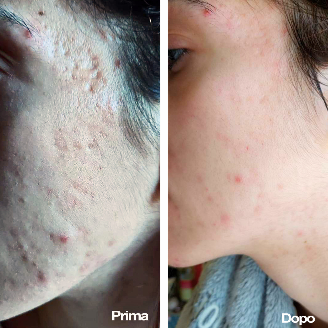Anti inflammatory-acne treatment