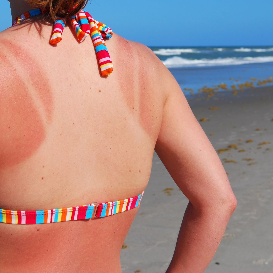 Come curare la pelle scottata dal sole? Scopri i rimedi semplici ed efficaci!