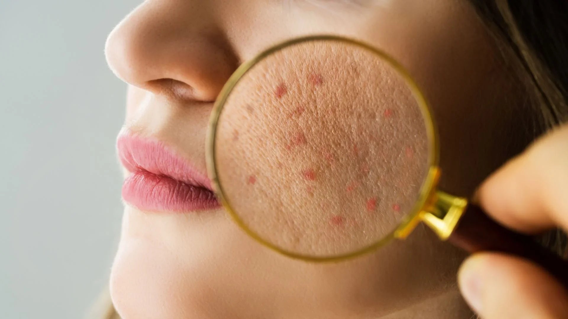 Pelle acneica? Ecco l'ingrediente che risolverà il tuo problema: l'acido lattico