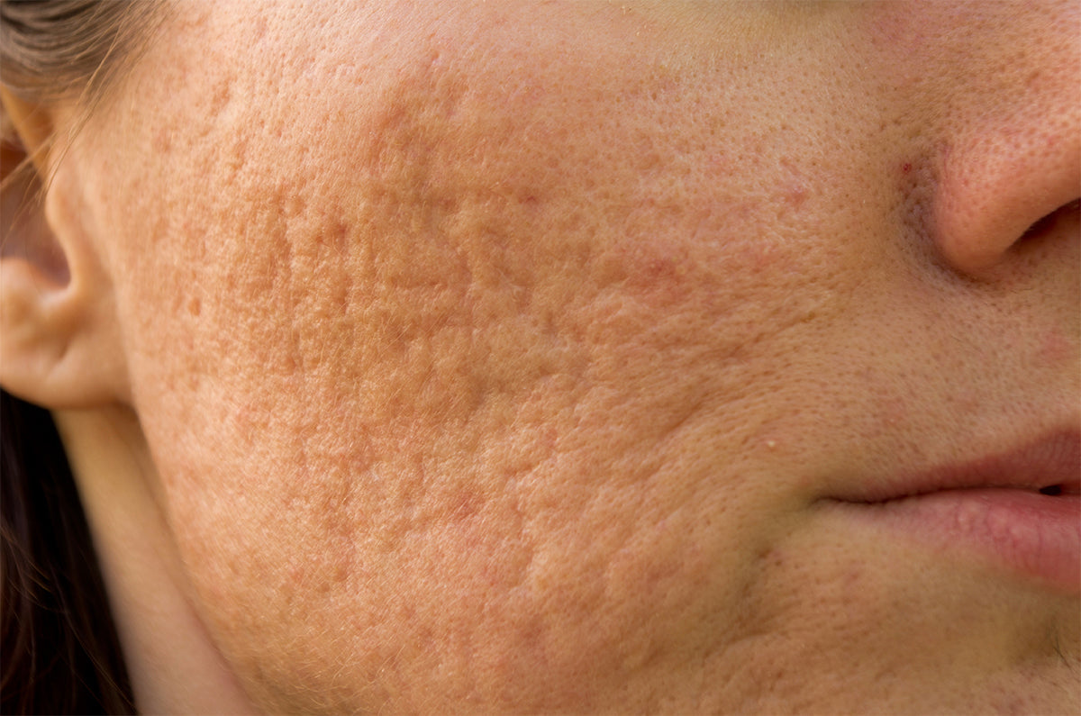 Cicatrici da acne | Rimedi naturali e skincare efficace – Lagalene